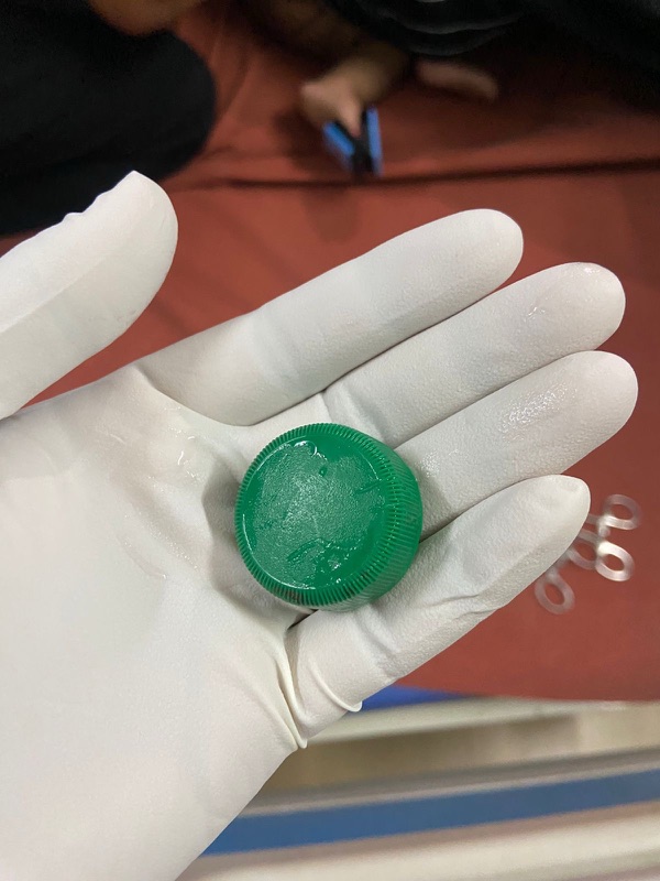 മഞ്ചേരി മെഡിക്കൽ കോളേജിൽ പത്തു മാസം പ്രായമുള്ള കുഞ്ഞിന്റെ ജീവൻ രക്ഷിച്ചു; തൊണ്ടയിൽ കുടുങ്ങിയ ബോട്ടിൽ അടപ്പ് നീക്കം ചെയ്തു